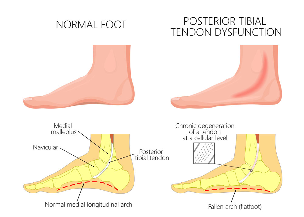 Tibialis posterior­tendinitis